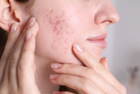 Peau acnéique avec rougeurs et imperfections, nécessitant un savon doux et purifiant adapté aux peaux à tendance acnéique.